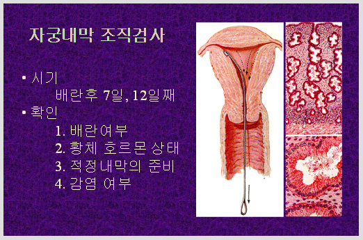 자궁내막 조직검사 : 시기 - 배란후 7일, 12일 , 확인 : 1.배란여부, 2. 황체 호르몬 상태, 3.적정내막의 준비, 4.감염여부